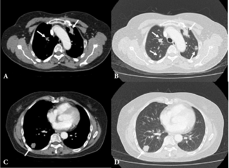 Multiple Pulmonary Nodules Mimicking Metastasis In A Case Of Systemic