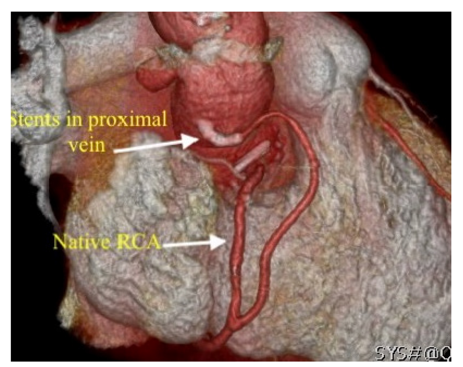 Post-operative contrast CT scan: volume rendered image showing coronary stents in the SVG.