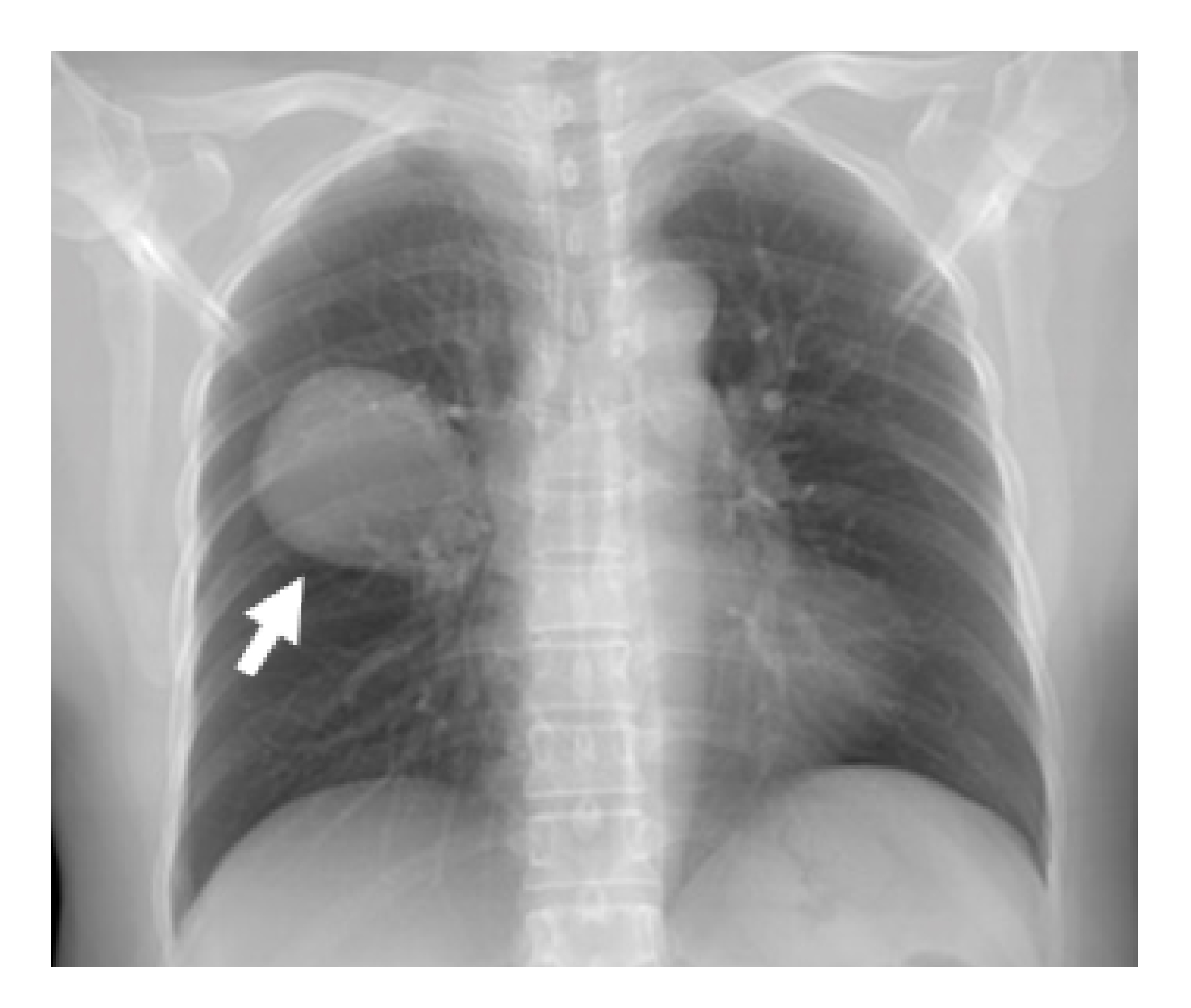 Frontal chest radiograph reveals a well-defined mass at right perihilar region